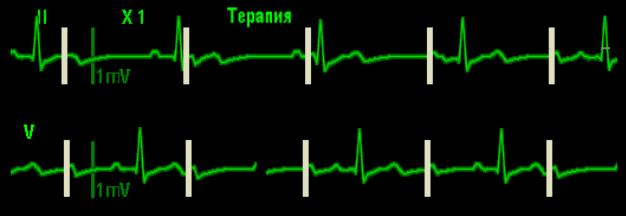 Маркеры кардиостимуляции на ЭКГ